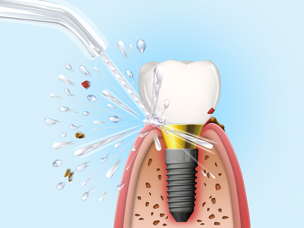 Aquapick Ağız Duşu İle Implant Temizliği