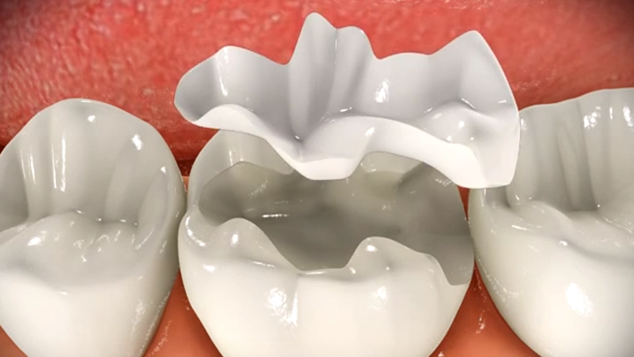 Inlay-Onlay (Porselen Dolgular) Nedir?