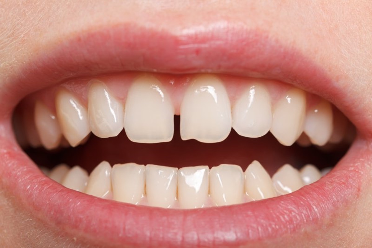 Diastema (Ayrık Diş) Nedir?
